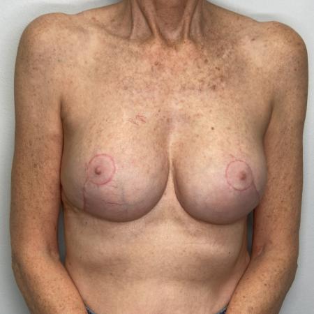 After image 1 Case #130536 - Complex Augmentation Mastopexy Revision