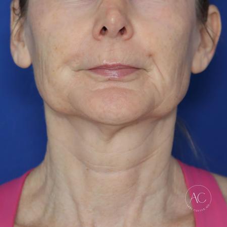 Before image 1 Case #130666 - Face and neck lift