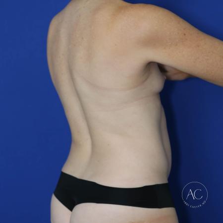 Before image 4 Case #130611 - Breast aug w/ fat transfer and implants, aplasty