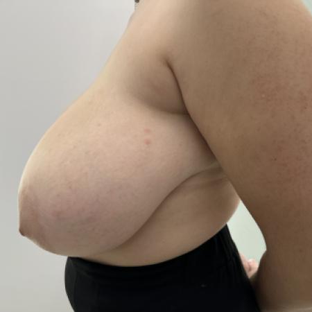 Before image 2 Case #130481 - Breast Reduction