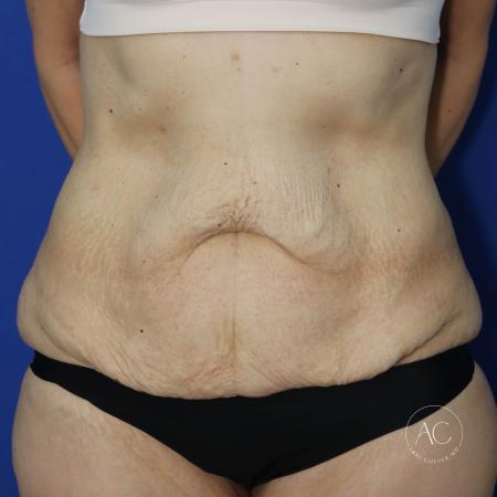 Before image 1 Case #130651 - Extended abdominoplasty after weight loss