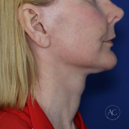 After image 3 Case #130666 - Face and neck lift