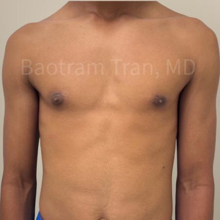 After image 1 Case #130516 - Gynecomastia Surgery