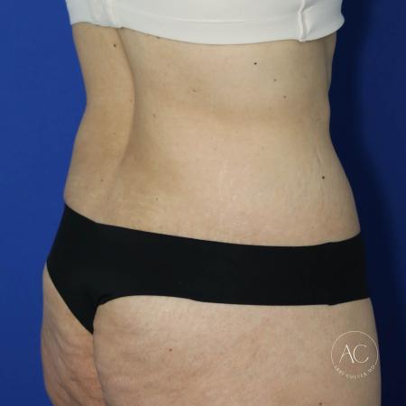 After image 4 Case #130651 - Extended abdominoplasty after weight loss