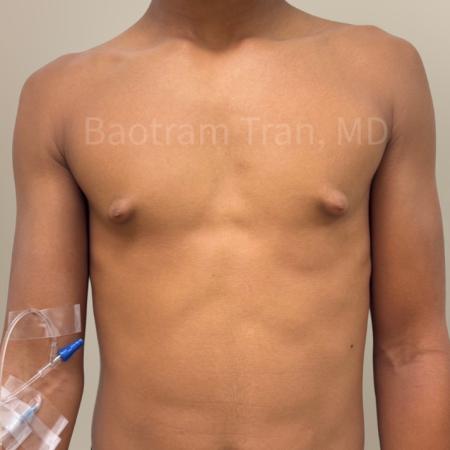 Before image 1 Case #130516 - Gynecomastia Surgery