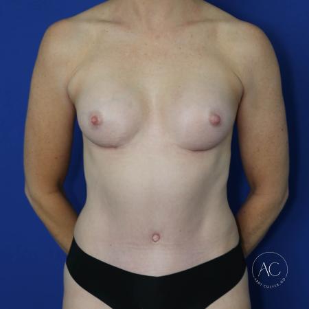After image 1 Case #130611 - Breast aug w/ fat transfer and implants, aplasty