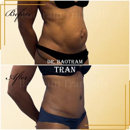 Before image 2 Case #130461 - Tummy tuck