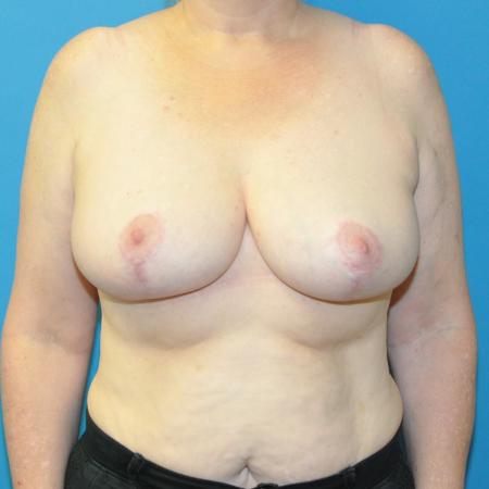 After image 1 Case #130301 - Breast Reduction