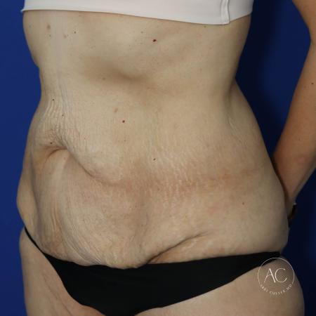 Before image 2 Case #130651 - Extended abdominoplasty after weight loss