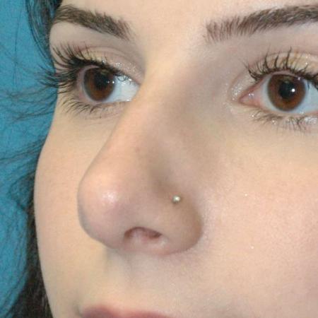 After image 1 Case #130161 - Primary Rhinoplasty