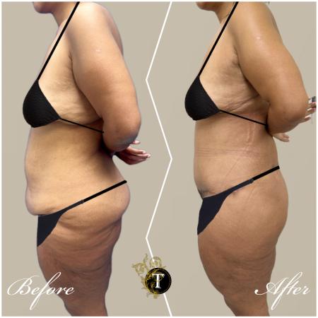 Before image 3 Case #130451 - Tummy tuck and Lower body lift and liposuction