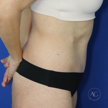 After image 3 Case #130651 - Extended abdominoplasty after weight loss