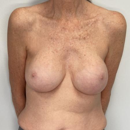 Before image 1 Case #130536 - Complex Augmentation Mastopexy Revision