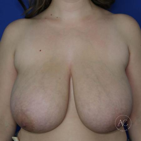 Before image 1 Case #130661 - Breast reduction