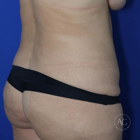 Before image 4 Case #130596 - Circumferential trunk liposuction, abdominoplasty