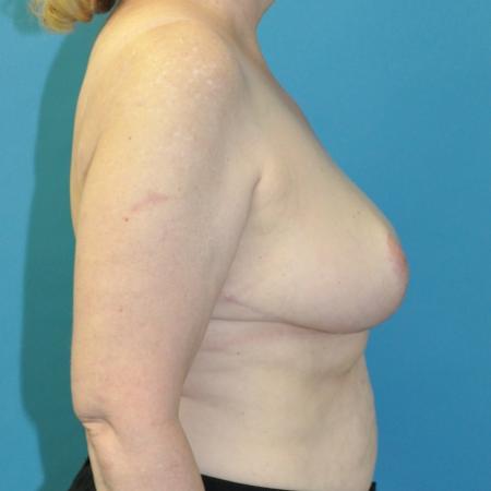 After image 3 Case #130301 - Breast Reduction