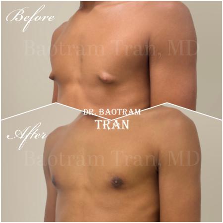 Before image 2 Case #130516 - Gynecomastia Surgery