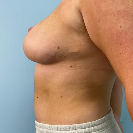 After image 3 Case #130211 - 22 y.o. female with Breast Reduction