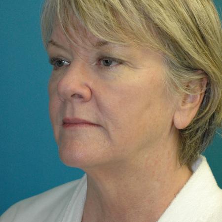 Before image 2 Case #130336 - Face and Necklift