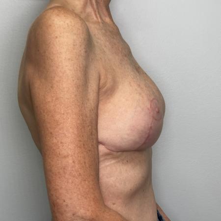 After image 2 Case #130536 - Complex Augmentation Mastopexy Revision