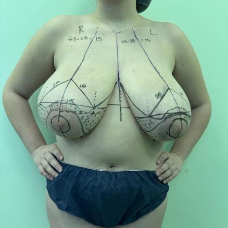 Before image 4 Case #130481 - Breast Reduction