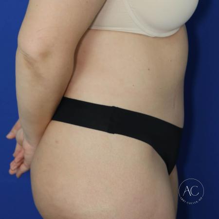 After image 3 Case #130596 - Circumferential trunk liposuction, abdominoplasty