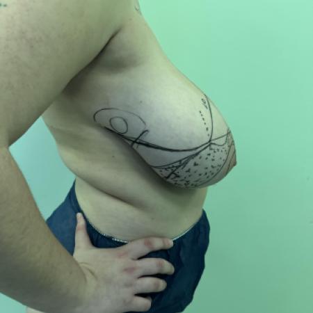 After image 4 Case #130481 - Breast Reduction