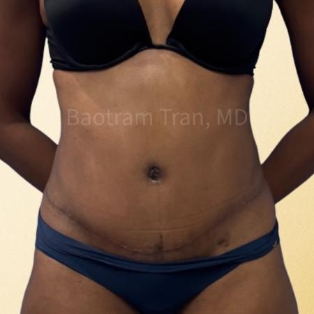 After image 1 Case #130461 - Tummy tuck