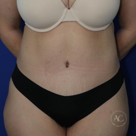After image 1 Case #130596 - Circumferential trunk liposuction, abdominoplasty