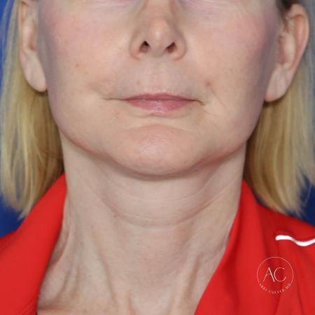 After image 1 Case #130666 - Face and neck lift
