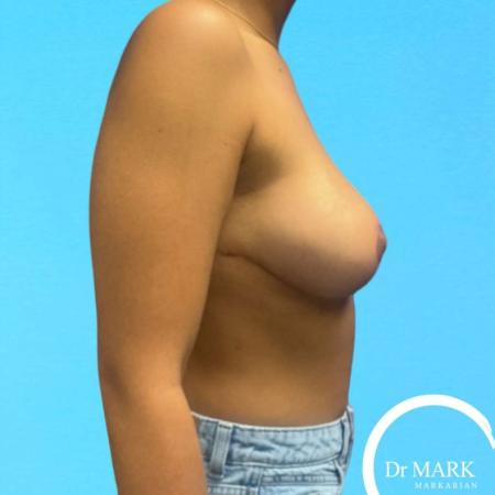 After image 5 Case #130766 - Breast reduction -- perkier and fuller result!