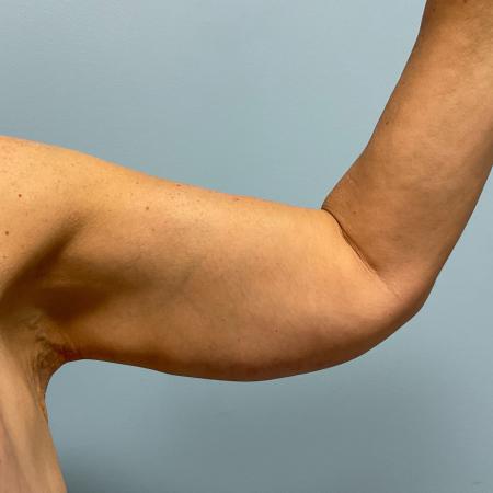 After image 3 Case #130776 - 58 y.o female with Bilateral Arm Lift