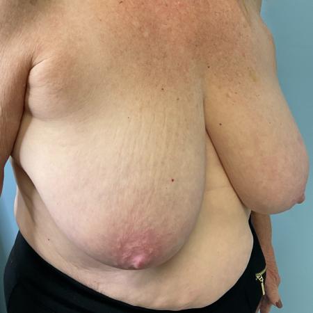 Before image 2 Case #130876 - 67 y.o female with Breast Reduction