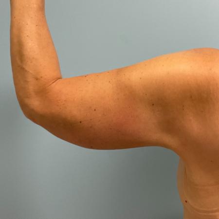 After image 1 Case #130776 - 58 y.o female with Bilateral Arm Lift