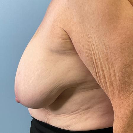 Before image 3 Case #130876 - 67 y.o female with Breast Reduction