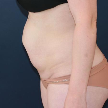 Before image 3 Case #130676 - Abdominoplasty