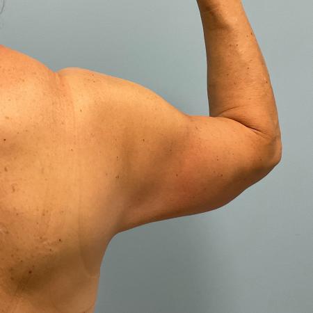 After image 2 Case #130776 - 58 y.o female with Bilateral Arm Lift