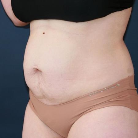 Before image 2 Case #130676 - Abdominoplasty