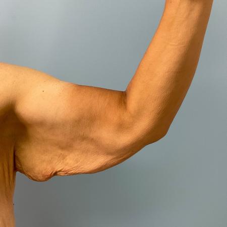 Before image 3 Case #130776 - 58 y.o female with Bilateral Arm Lift