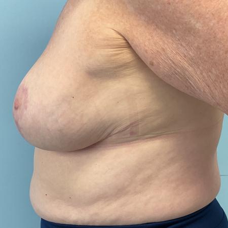 After image 3 Case #130876 - 67 y.o female with Breast Reduction