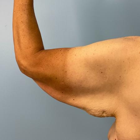 Before image 1 Case #130776 - 58 y.o female with Bilateral Arm Lift