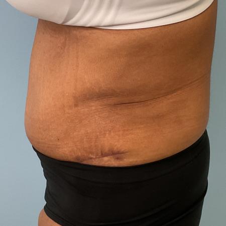 After image 3 Case #131026 - 54 y.o. female with Tummy Tuck & Lipo of Flanks