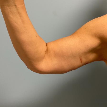 After image 4 Case #130776 - 58 y.o female with Bilateral Arm Lift