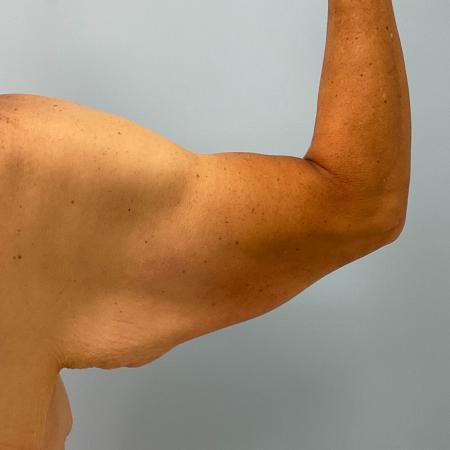 Before image 2 Case #130776 - 58 y.o female with Bilateral Arm Lift