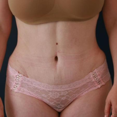 After image 1 Case #130676 - Abdominoplasty