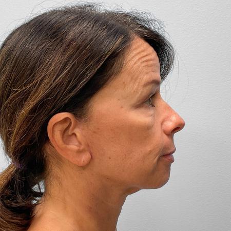 After image 3 Case #133111 - Facelift & Laser Resurfacing