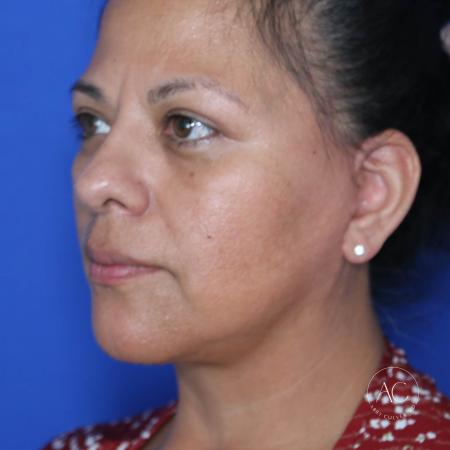After image 2 Case #132266 - Face and necklift with upper/lower blepharoplasty 