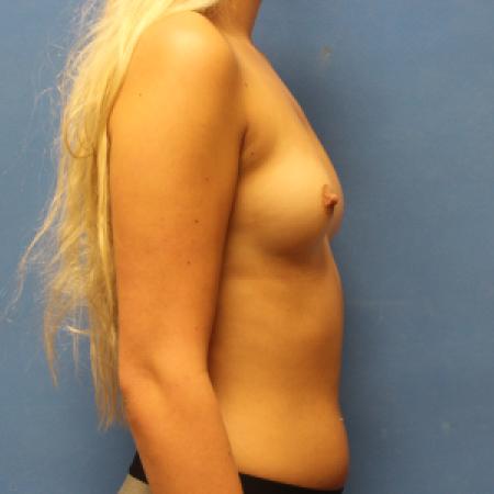 Before image 5 Case #131711 - Breast Augmentation Rao Plastic Surgery Tucson, AZ