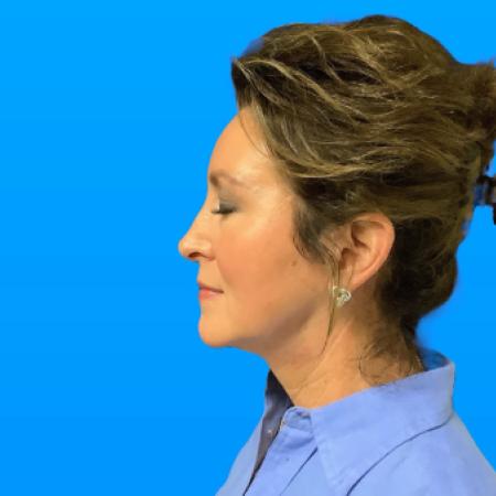 After image 3 Case #133146 - SMAS Facelift 