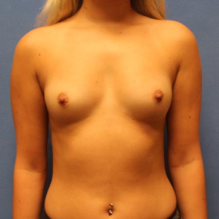 Before image 1 Case #131711 - Breast Augmentation Rao Plastic Surgery Tucson, AZ